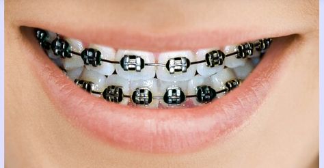 More braces Braces With Black Bands, Braces Colors Black, Black Braces Teeth, Dental Braces Colors, Braces Colors Combinations, Braces Black, Braces Bands, Black Braces, Cute Braces Colors