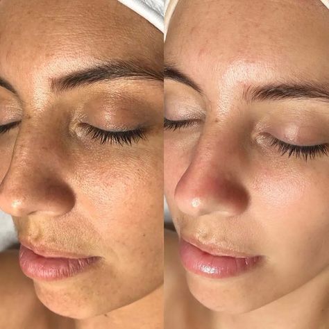 Skin Before And After, Hydra Facial Before And After, Hydrafacial Before And After, Facial Before And After, Facial Benefits, Remove Skin Tags Naturally, Skin Poster, Oxygen Facial, Microcurrent Facial