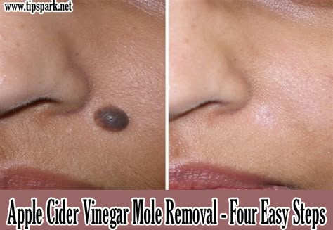 ... Home Remedies For Skin, Skin Moles, Mole Removal, Beauty Remedies, Beauty Recipe, Diy Health, Homemade Beauty Products, Natural Home Remedies, Health And Beauty Tips