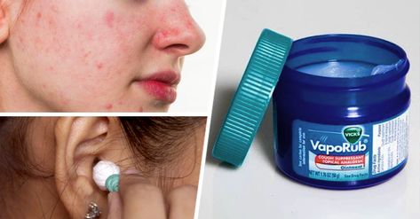 Usos que puedes darle al Vick VapoRub y no sabías que tiene Vicks Vaporub, Cotton Ball, Fitbit Flex, Fitbit