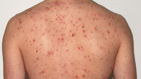 Internal shingles: What to know about shingles without a rash Cassava Leaves, Shingles Rash, May Spread, Rash On Neck, Itchy Rash, Medical Pictures, Internal Organs, Home Health Remedies, Nerve Pain