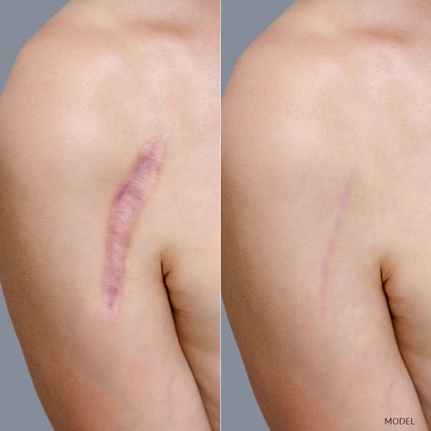 Arm Scar Reference, Scar Aethstetic, Scar Ideas, Facial Scarring, Scar Reference, Scar Revision, Umibe No Onnanoko, Fake Scar, Hypertrophic Scars