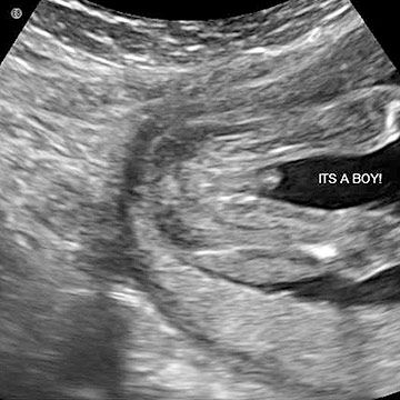 18 Week Ultrasound: Male Gender Reveal Ultrasound Boy Or Girl, Ultrasound Pictures Gender, Boy Ultrasound Pictures, Baby Gender Ultrasound, Fetal Development Week By Week, Boy Ultrasound, Baby Boy Signs, Pregnancy Videos, Baby Ultrasound