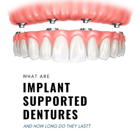 The middle ground between conventional dentures, and the more expensive full-arch dental implant solution. This is a great affordable solution for individuals looking to improve their ability to chew and smile. Some of the main benefits of implant-supported dentures are: (1) Affordable option for significant improvement (2) Sturdy and don’t require the use of adhesive (3) Function and look like natural teeth (4) Easy to clean and maintain (5) Preserves bone and gum tissue Snap On Dentures Uk, Permanent Dentures, Dental Animation, Affordable Dentures, Denture Implants, Brighten Teeth, Dental Videos, Medical Animation, Dental Implant