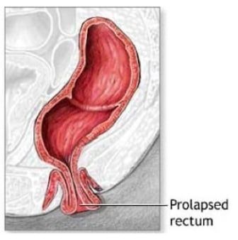 rectal prolapse Prolapse Exercises, Bristol Stool Chart, Bladder Prolapse, Rectal Prolapse, Pelvic Floor Muscle Exercise, Pelvic Floor Therapy, Wellness Videos, Pelvic Organ Prolapse, Pelvic Floor Dysfunction