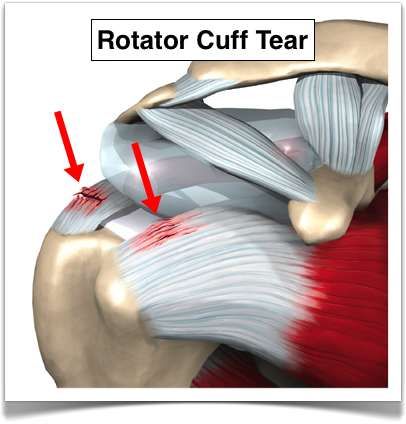 Rotator Cuff Rehab, Shoulder Anatomy, Rotator Cuff Surgery, Rotator Cuff Exercises, Psoas Release, Shoulder Rehab, Rotator Cuff Tear, Rotator Cuff Injury, Shoulder Surgery