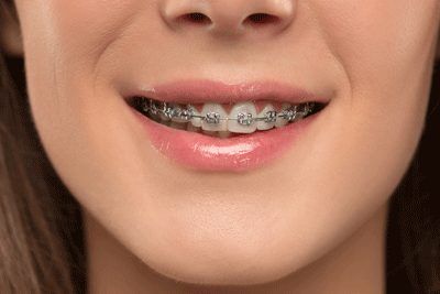 Types Of Bridges, Tooth Bridge, Braces Dentist, Braces Cost, Teeth Whitening Procedure, Braces Tips, Traditional Braces, Get Whiter Teeth, Discolored Teeth