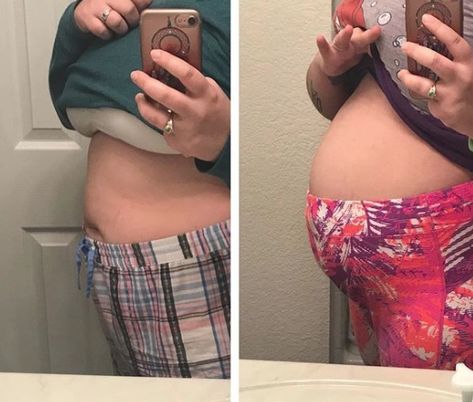 Women share photos of their bloated bellies to show painful reality of living with endometriosis Female Health Problems, Endo Belly, Average Woman, Bloated Belly, Leg Pain, Abdominal Pain, Hot Flashes, Health Problems, Womens Health