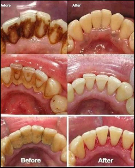 Scaling Teeth, Good Teeth, Karang Gigi, Dental Wall Art, Dental Pictures, Dental Business Cards, Dental Posters, Dental Videos, Kedokteran Gigi