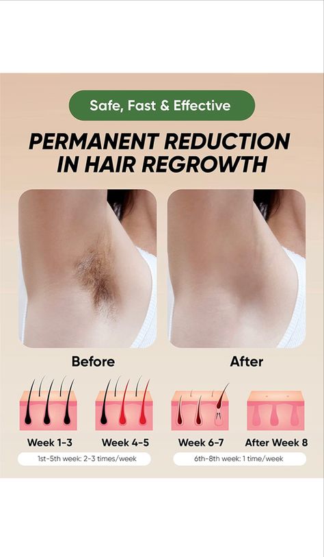 70% off! | Laser Hair Removal | Only $59.85! Great Amazon Finds, Healthy Clean Eating Recipes, Underarm Hair Removal, Hair Growth Secrets, Laser Hair Removal Machine, Permanent Hair Removal, At Home Hair Removal, Ditch The Carbs, Hair Removal Machine