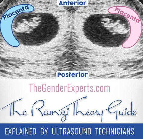 Sonogram Gender Prediction, Ramsey Theory Baby Gender, Fetal Heart Rate Gender, 10 Week Ultrasound Pictures, Baby Heart Rate Gender, Ultrasound Boy Or Girl, Ultrasound Pictures Gender, Boy Ultrasound Pictures, Baby Gender Ultrasound