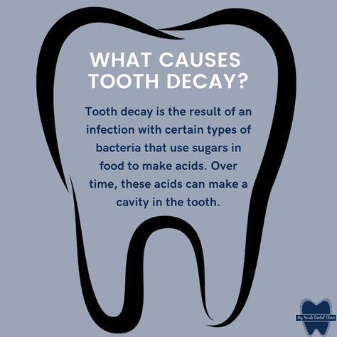 Tooth decay is damage to a tooth's surface, or enamel. It happens when bacteria in your mouth make acids that attack the enamel. Tooth decay can lead to cavities (dental caries), which are holes in your teeth. If tooth decay is not treated, it can cause pain, infection, and even tooth loss. Dental Awareness, Dental Post, Severe Tooth Pain, Hygiene School, Dental Assistant Study, Dental Quotes, Dental Advertising, Dental Studio, Dental Cabinet