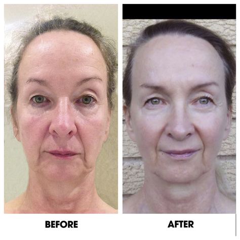 Face Yoga Before and After Images – Face Yoga Australia Face Yoga Method, Face Cream For Wrinkles, Face Yoga Exercises, Yoga Inspo, Facial Yoga, Yoga Program, Forehead Wrinkles, Yoga Photos, Yoga Facial