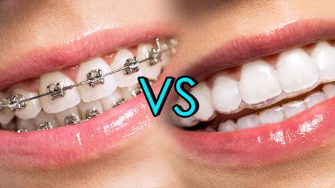 Fixed Braces, Ceramic Braces, Braces Cost, Invisalign Braces, Getting Braces, Traditional Braces, Invisible Braces, Dental Braces, Metal Braces