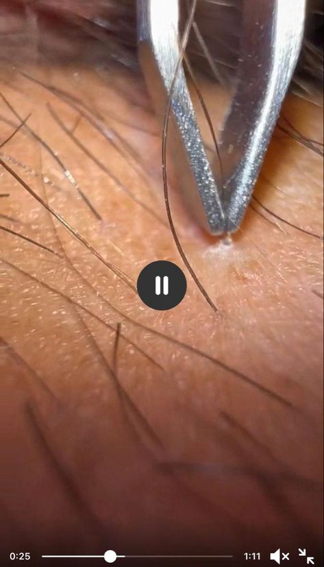 How To Get Rid Of Ingrown Hairs, Ingrown Hair Removal Videos, Remove Ingrown Hair, Blackheads Removal Cream, Ingrown Hair Remedies, Shaving Bumps, Blackhead Remover Diy, Baking Soda For Hair, Ingrown Hair Removal