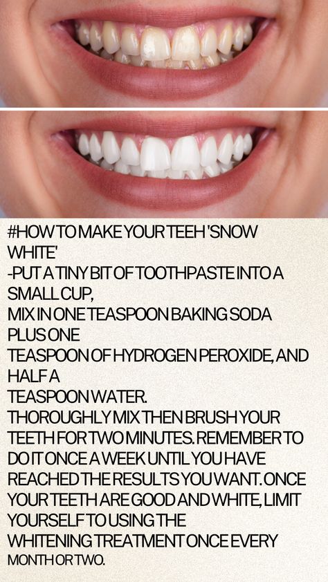 Before and after comparison of teeth whitening using a DIY mixture of toothpaste, baking soda, hydrogen peroxide, and water, with clear instructions for the process. Straighten Teeth At Home Diy, How To Get White Teeth, Straighten Teeth At Home, Teeth Whitner, Diy Teeth Whitening, White Teeth Diy, Uses For Toothpaste, White Teeth Tips, Hydrogen Peroxide Teeth