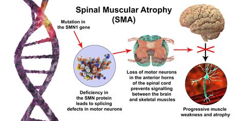 Spinal Muscular Atrophy (SMA) | Reeve Foundation Spinal Muscular Atrophy, Nerve Cells, Motor Neuron, Muscle Atrophy, Research Poster, Oral Motor, The Nerve, Gene Therapy, Muscle Weakness