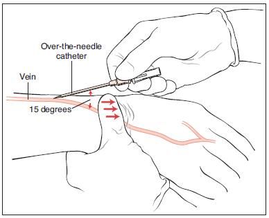 Angle for IV insertion. Don't forget to pull the skin towards you to anchir the vein! ! Iv Injection, Iv Insertion, Nursing School Inspiration, Medical Assistant Student, Nursing School Essential, Medical School Life, Nursing School Motivation, Basic Anatomy And Physiology, Nurse Study Notes