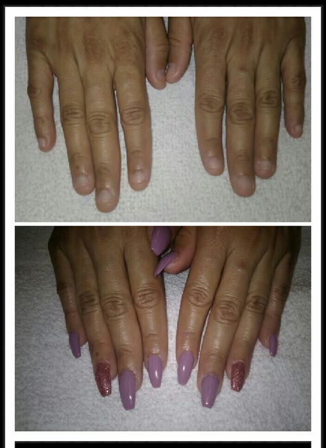 Before and after Small nail beds.  Acrylic nails Acrylics On Short Nail Beds, Before And After Nails, Wide Nail Beds, Short Nails Short Nail Bed, Bitten Nails Before And After, Short Nails Wide Nail Bed, Nail Recovery After Gel, Short Nail Bed French Tip, Short Nail Bed