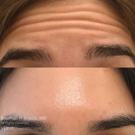 Forehead Filler, Allergan Botox, Forehead Lines, Different Types Of Acne, Botox Before And After, Botox Filler, Cosmetic Injectables, Types Of Acne, Botox Fillers