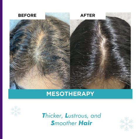 Mesotherapy Hair, Hair Structure, Skin And Hair Clinic, Scalp Treatments, Cosmetic Clinic, Hair Clinic, Fit Motivation, Hair Scalp, Hair Regrowth