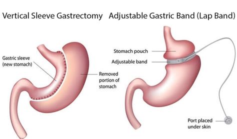 Vertical Sleeve Gastrectomy, Bariatric Sleeve, Lap Band, Gastric Band, Sleeve Gastrectomy, Sleeve Surgery, Body Goals, Fitness Tips, Make You Feel