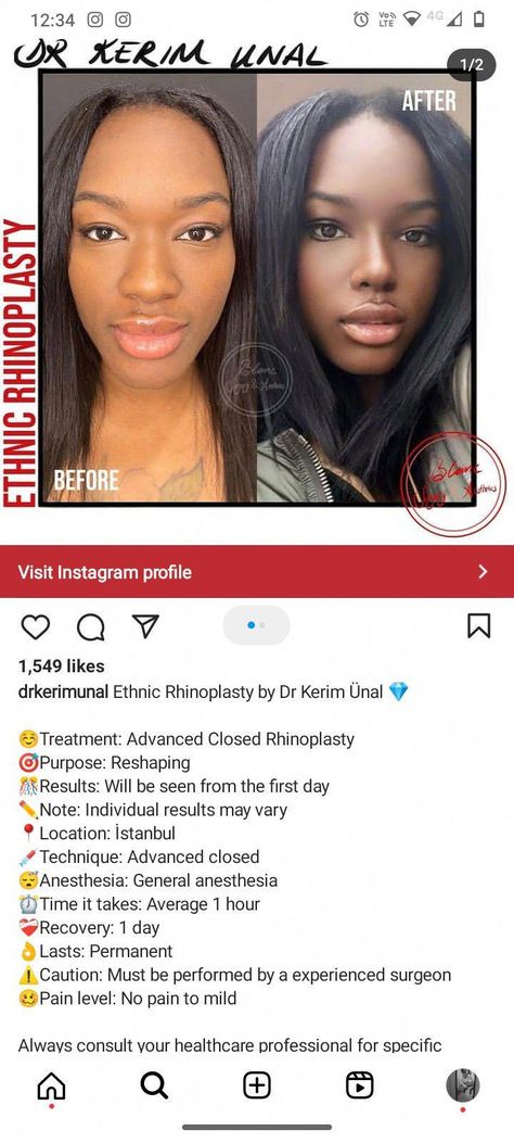 Black Rhinoplasty Before And After, Rhinoplasty Before After Wide Nose Jobs, African American Rhinoplasty, Rhinoplasty Black Women, Black Nose Job, Ethnic Rhinoplasty African Americans, Nose Job Black Women, Wide Nose Women, Flat Nose Asian