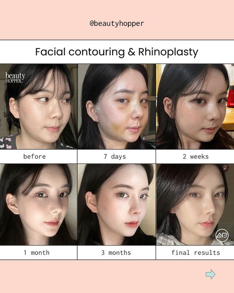 Changing your facial shape and proportion can be an extremely powerful tool to amplifying your beauty✨ For the above procedures, we recommend you to stay a minimum of 2 weeks in Korea. 👉🏻Whether you are seeking a subtle refinement or a more dramatic transformation, we can guide you to the best surgeon capable of achieving the aesthetic you desire. We’re here to help you have a safe and successful makeover in Korea. Contact us for a free consultation ⬇️⬇️⬇️ 💌: contact@beautyhopper.com 📲... Rhinoplasty Recovery, Plastic Surgery Korea, Korean Facial, Rhinoplasty Before And After, Beauty Procedures, Fat Grafting, Facial Contouring, Celebrity Plastic Surgery, Botox Fillers