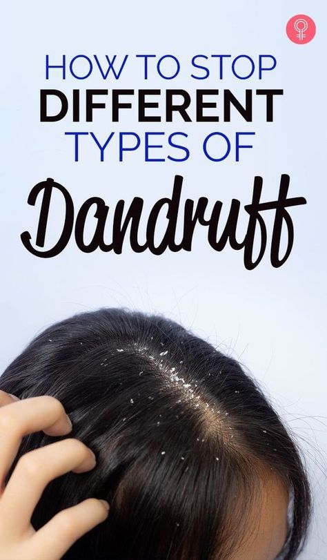 Severe Dandruff, Dandruff Causes, Home Remedies For Dandruff, Dandruff Flakes, Upper Lip Hair, Stop Hair Breakage, Essential Oils For Pregnancy, Dandruff Remedy, Getting Rid Of Dandruff