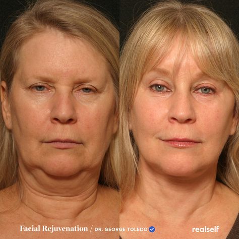 Excess droopy skin along the jawline and below the cheeks is commonly referred to as jowls. These nonsurgical and surgical procedures can help tighten the skin. How To Lift Sagging Jowls, How To Help Sagging Jowls, Sagging Facial Skin, How To Tighten Saggy Jowls, How To Tighten Jawline, Tighten Saggy Jowls, Neck Lift Naturally, How To Reduce Sagging Jowls, Plasma Fibroblast Before And After Neck