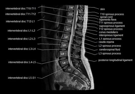 MRI lumbar spine sagittal cross sectional anatomy image 7 Cross Sectional Anatomy, Lumbar Spine Anatomy, Mri Spine, Mri Anatomy, Diagnostic Radiography, Spine Anatomy, Medical Radiography, Ultrasound Sonography, Mri Brain