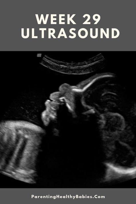 #week29pregnancy #ultrasound #ultrasoundat29weeks 29 Week Pregnancy, 29 Weeks Pregnant, 30 Weeks Pregnant, 30 Weeks, Ultrasound Pictures, Pregnancy Week By Week, Healthy Babies, Ultrasound, Pregnancy Tips