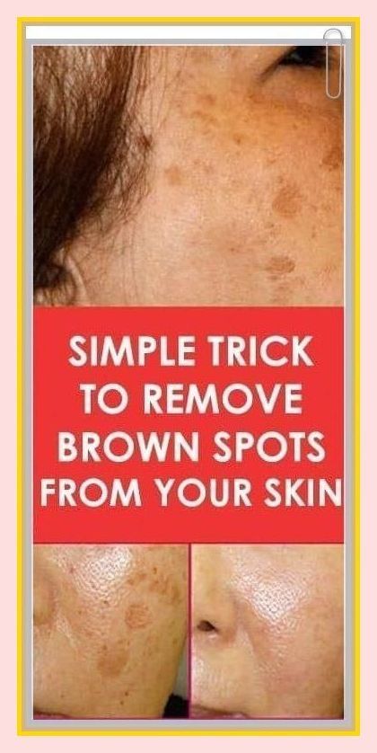 SIMPLE TRICK TO REMOVE BROWN SPOTS FROM YOUR SKIN Black Spots On Face, Sunspots On Face, Brown Spots On Hands, Brown Age Spots, Age Spot Removal, Brown Spots On Skin, Spots On Legs, Dark Spots On Face, Brown Spots Removal