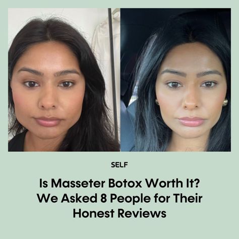 If you regularly wake up with a sore jaw, chances are you’ve come across masseter Botox as a possible remedy. Yep, even though botulinum toxin (the scientific name for Botox) is most known for its ability to temporarily smooth facial wrinkles, it’s got some research-backed medical benefits, too. But, like with anything, there are always risks. We asked eight people who got the injections if the results lived up to the hype—and justified the price. Tap the link in bio for their answers. Masseter Botox Before And After, Sore Jaw, Botox Before And After, Botulinum Toxin, Facial Wrinkles, Scientific Name, The Hype, Wrinkles, Wake Up