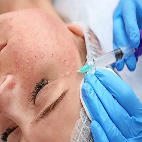 ● Delivery of Hyaluronic acid (HA) into the superficial and middle layer of the skin can be done in various ways, including micro-injections, microneedling pens, mesoguns and mesostamping. ● Bioreviatalization - involves micro-injections of Hyaluronic acid (HA) and nutrients into superficial and middle layer of skin. #vidaskinbeautycenter #skinbeautycenter #skincare #skincareroutine #agelessbyabovian #beauty #makeup #skin #lipocavitation #biorevitalization Dilated Pores, Aesthetic Dermatology, Skin Spots, Reconstructive Surgery, How To Look Handsome, Deep Wrinkles, Layers Of Skin, Health Magazine, Improve Skin Elasticity