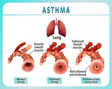 Bronchial asthma diagram with normal air... | Free Vector #Freepik #freevector #physiology #human-anatomy #human-lungs #pulmonary Nicu Nurse Education, Bronchial Asthma, Asthma Relief, Human Lungs, Constant Headaches, Pulmonology, Respiratory Therapy, Lungs Health, Nursing Education