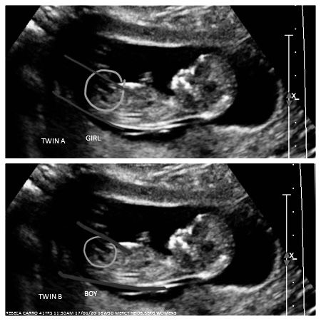 Twins Ultrasound 6 Weeks, 13 Week Ultrasound, Ultrasound Student, Twins Ultrasound, Sonography Student, Pregnancy Ultrasound, Ultrasound Technician, Baby Ultrasound, Ultrasound Tech