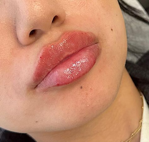 Russian lip technique 💉 #lipfiller #russianlips #russianliptechnique Russian Lips Filler 1ml, Lip Filler Inspiration 1ml, Round Lips Filler, Russian Lip Filler Technique, Lip Fillers Before And After 1ml, Downturned Lips, Russian Lips Filler, Lip Pmu, 1ml Lip Filler