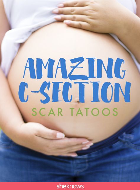 You will never believe what these moms did with their C-section scars Tattoo For C Section Scar, Acl Scar Tattoo Cover Up, C Section Tatoos, Tattoo To Cover C Section, C Section Tattoos For Women, Chest Port Scar Tattoo, Tattoo Over C Section Scar, Cesarean Tattoo Cover Up, C Section Scar Tattoo Ideas