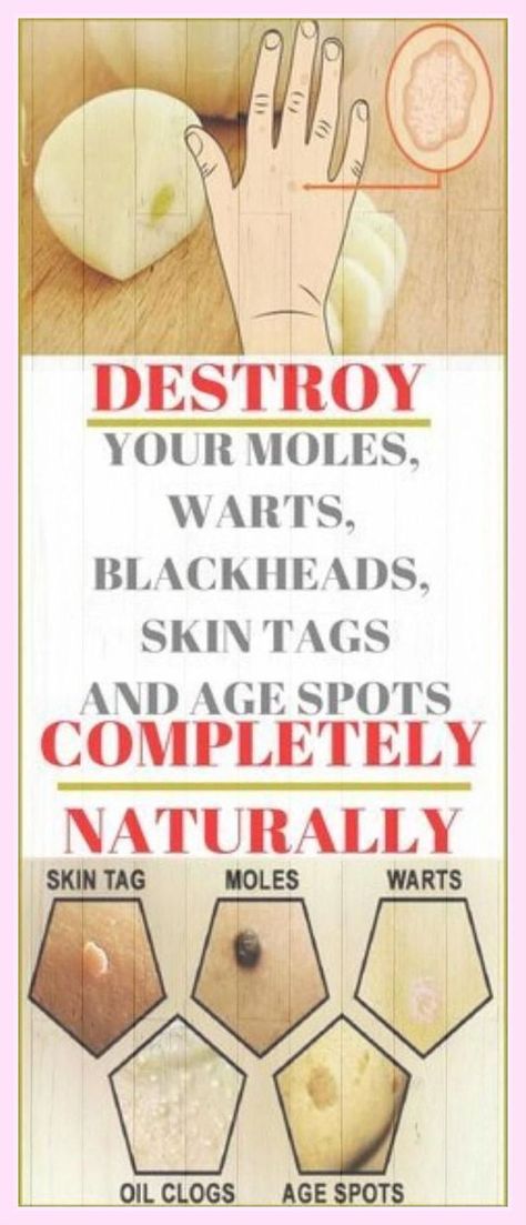 Destroy Your Moles, Warts, Blackheads, Skin Tags and Age Spots Completely Naturally Natural Wart Remedies, Fresh Aloe Vera Gel, Skin Moles, Get Rid Of Warts, Skin Tags, Natural Healing Remedies, Natural Therapy, Hormone Imbalance, Skin Issues