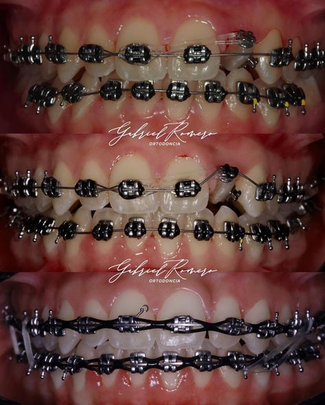 Braces Patterns, Braces Power Chain, Invisalign Hacks, Power Chain Braces, Braces Colors Combinations, Braces Before And After, Braces And Glasses, Braces Smile, Power Chain