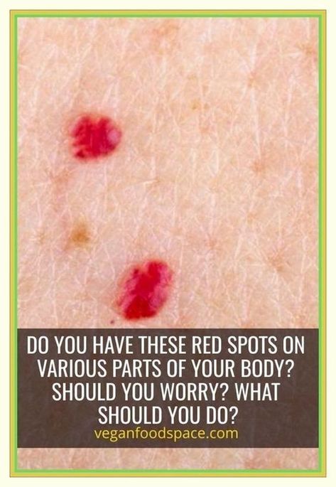 Board name Red Spots On Face, Red Skin Spots, Cherry Angioma, Workout Plan Home, Elbow Pain Relief, Sagging Cheeks, Cleaning Dogs Ears, Red Moles, Lemon Chicken Pasta