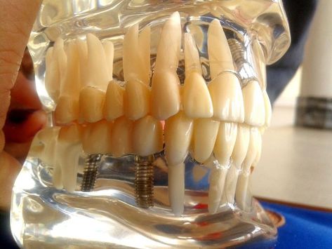 dental implants Best Dental Implants, Dental Implant Surgery, Dental Surgeon, Dental Hospital, Surgery Center, Dental Implant, Book An Appointment, Dental Implants, Pain Free