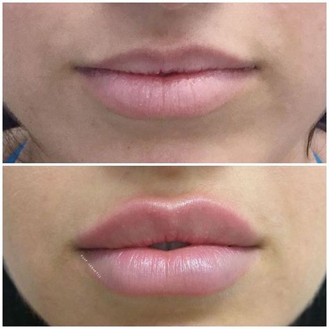 1ml of lip filler 4 weeks follow up , repost from last year . Thank you to my kind client for letting me share her results ( I am obsessed… Namjoon's Lips, Lip Fillers Juvederm, Cosmetic Nurse, Lip Surgery, Lips Inspiration, Botox Lips, Nurse Injector, Natural Mouthwash, Loona Kim Lip