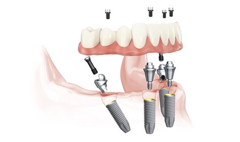 Dental implants for complete replacement of natural teeth.  - Smile Curve Dental Clinic, Indore All On 4 Dental Implants, Dentist Logo, Best Dental Implants, Tooth Replacement, Dental Products, Make Smile, Natural Teeth, Dental Services, Dental Office