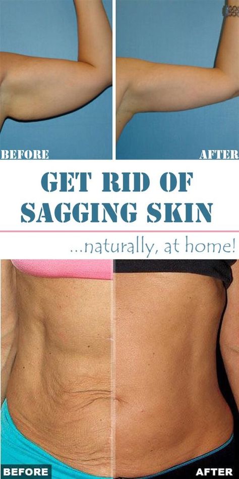 6 Wonderful home remedies for sagging skin Home Remedies For Skin, Tighten Loose Skin, Crepey Skin, Saggy Skin, Natural Health Tips, Trening Abs, Skin Remedies, Loose Skin, Skin Care Remedies