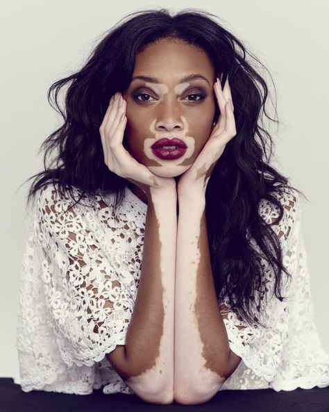 Chantelle Winnie - skin condition called vitiligo - “Diversity is the future of fashion” Chantelle Brown Young, Portrait Women, Make Up Foundation, Winnie Harlow, Face Beauty, Skin Disorders, Natural Beauty Tips, American Horror Story, Skin Conditions