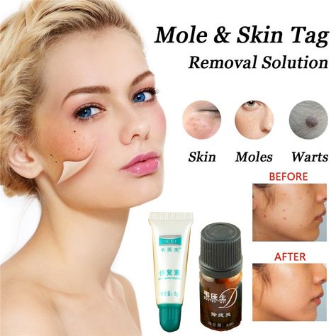 Sale Mole Pores and skin Tag Removing Resolution Painless Mole Pores and skin Darkish Spot Removing 1pc Face Wart Tag Freckle Removing and 2pcs Restore Cream Check more at https://beauty-and-health.catalogmargo.com/sale-mole-pores-and-skin-tag-removing-resolution-painless-mole-pores-and-skin-darkish-spot-removing-1pc-face-wart-tag-freckle-removing-and-2pcs-restore-cream/ Face Warts, Moles On Face, Skin Moles, Skin Tags, Mole, Beauty Makeup, Resolution, Cream, Skin