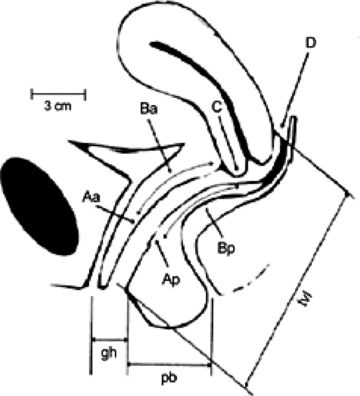 injury of the ‘levator ani nerve Levator Ani, Suture Material, Pelvic Organ Prolapse, Confidence Interval, Meta Analysis, Health Journal, After Surgery, Urinary Tract, Online Library