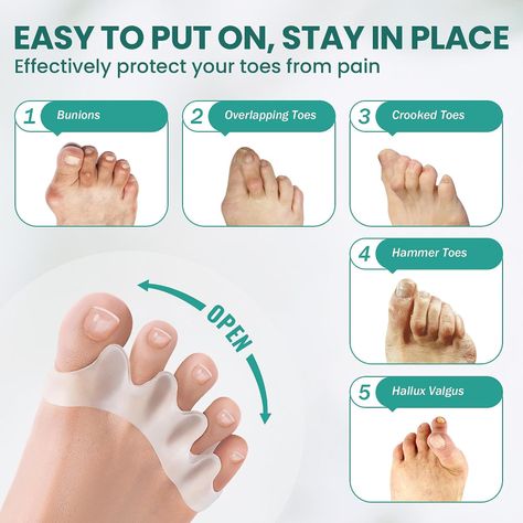 Amazon.com: Welnove Toe Separators to Correct Bunions - 8 Pack Silicone Toe Spacers for Feet Men Women - Aloe Vera Infused Toe Straighteners for Bunion, Hammertoe - Toe Stretchers for Yoga Practice : Health & Household Hammer Toe Correction, Toe Spacers, Toe Straightener, Toe Separator, Gel Toes, Improve Posture, Foot Care, Healthy Fitness, Silicone Material